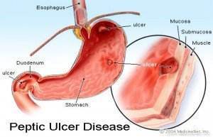 peptic_ulcer 09.09  - peptic ulcer 09 - Ulcerul gastro-duodenal