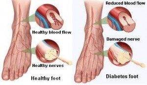 - feet Diabetes 12 - Persoanele care suferă de depresie și diabet zaharat sunt mai expuse riscului de picior diabetic